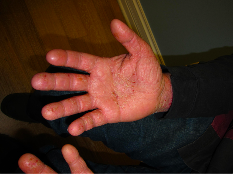 What Causes Eczema On Your Hands And How To Treat It - Bodewell