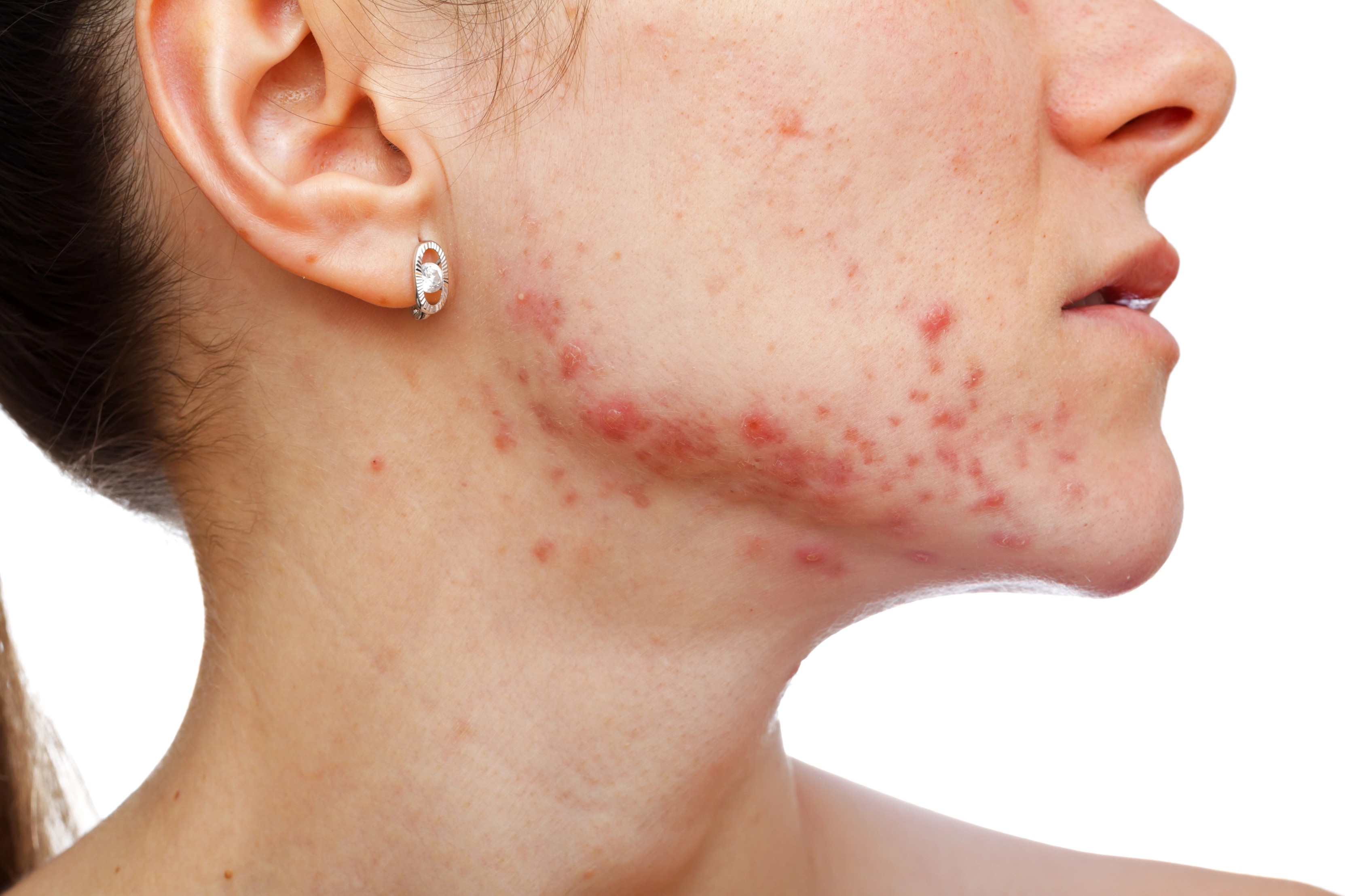 Insulin resistance in Mexican women with acne vulgaris