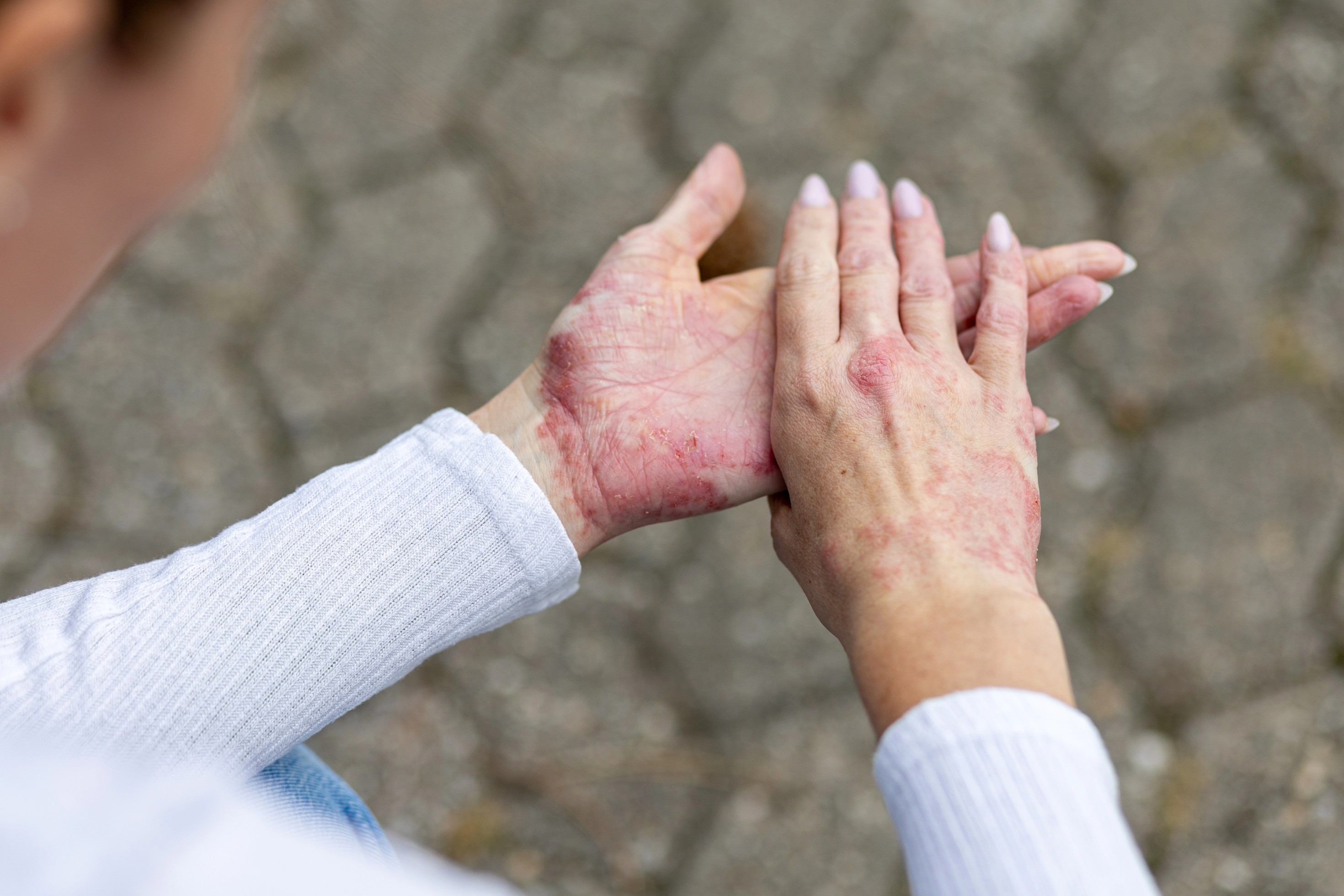 Effect of tralokinumab treatment in patients with moderate-to-severe atopic dermatitis and allergy-related conditions